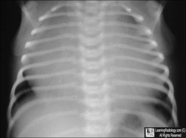 Ebsteins anomaly